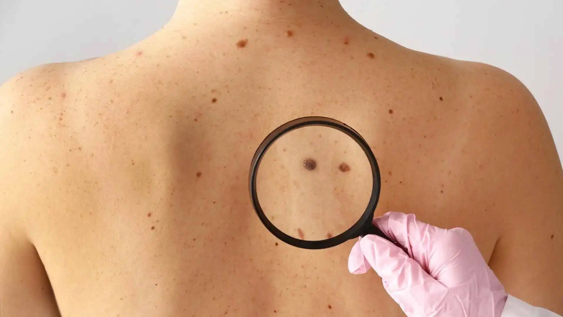Cáncer de piel