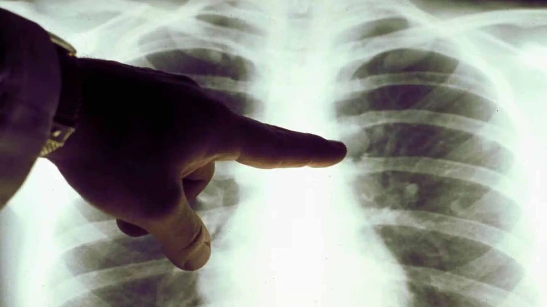 Cáncer de pulmón